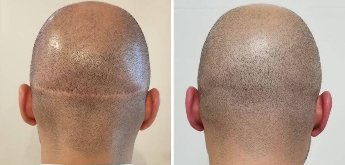 Fut hair outlet transplant