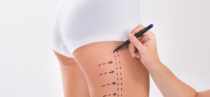 Liposuction