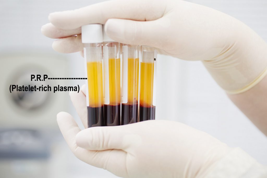 Platelet Rich Plasma