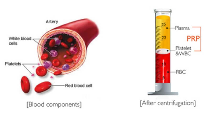 Platelet-rich plasma (PRP)